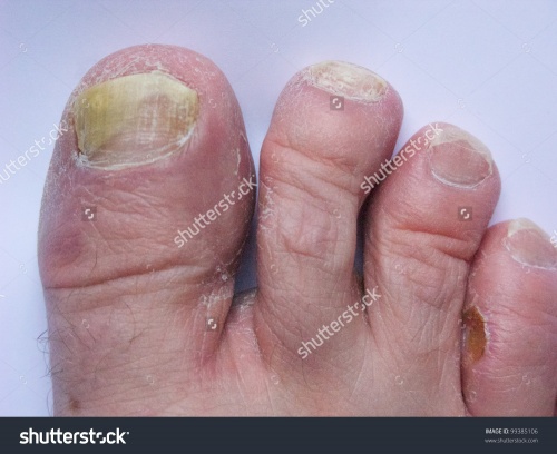 Alipunga - Athlete's foot.jpg