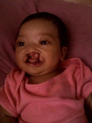 Athena Ria Gwyn Mandag, Born with Cleft Palate and Harelip 02.jpg