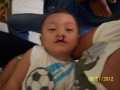 BOSS Surigao Toddler patient before operation.JPG