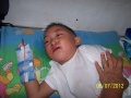 BOSS Surigao Toddler patient after operation.JPG